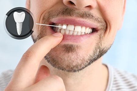 dental implants permanent