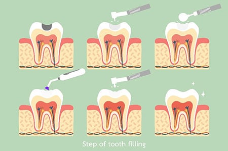 Tooth-Colored Fillings 