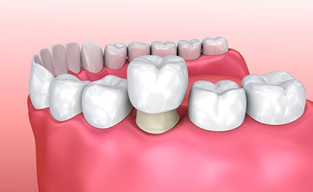 Dental Crown Recovery