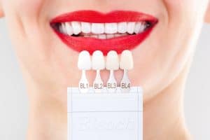 Porcelain veneers