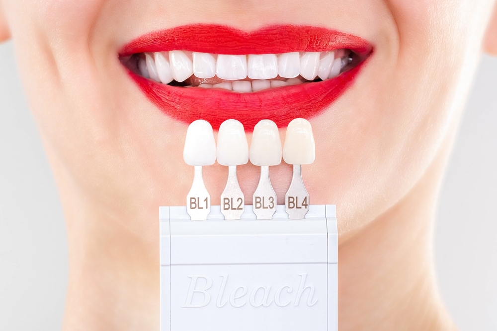 Porcelain veneers