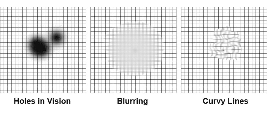 macular-degeneration-test-grid-amsler-grid-brevard-eye