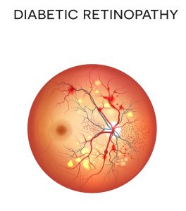 Diabetes increases your risk of eye disease in Suntree