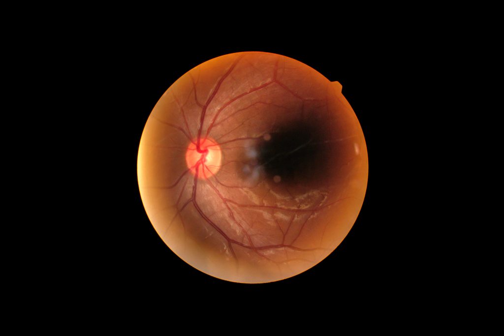 Illustration of eye affected by diabetic eye disease