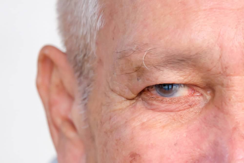 Close up of senior man's eye with glaucoma