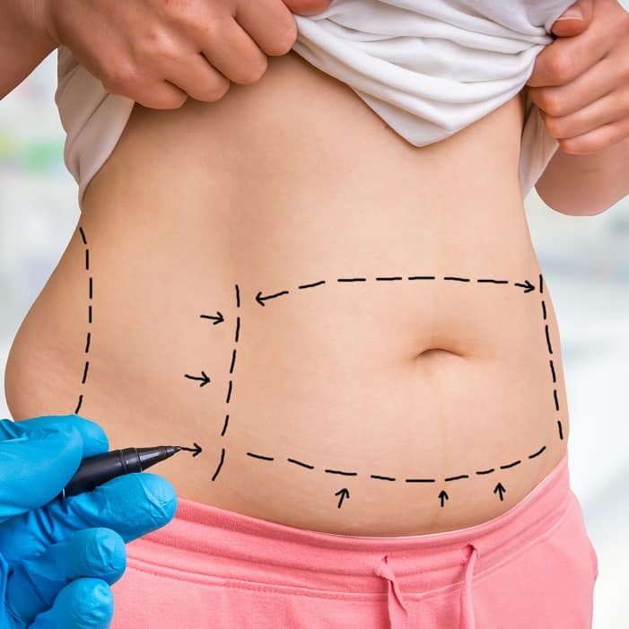 Tummy Tuck West Palm Beach Abdominoplasty Palm Beach