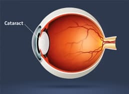 boston cataract surgery