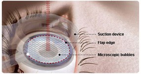 intralase lasik surgery boston ma