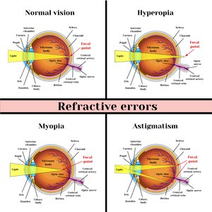 Refractive Eye Surgery Boston, MA