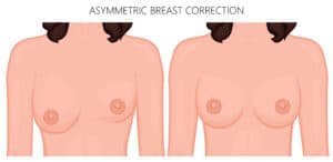 Asymmetrical Breast Surgeon Atlanta, GA