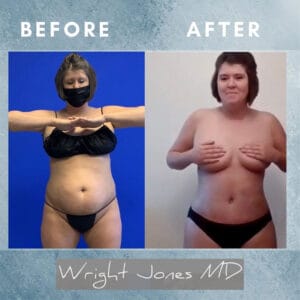 Body Contouring Patient Before and After