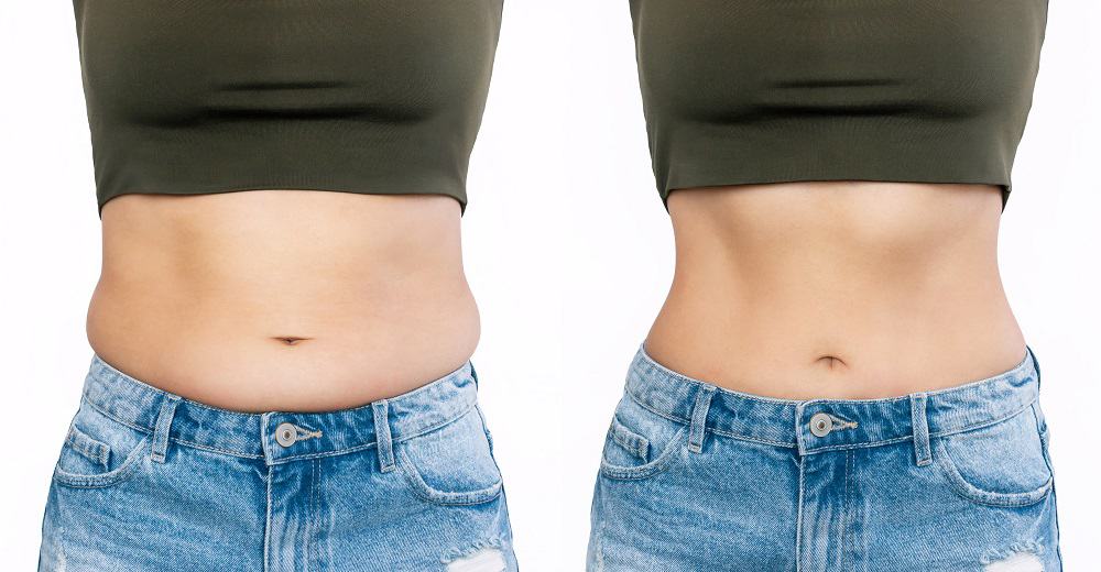Liposuction before and after images - Atlanta Lipo Surgeon